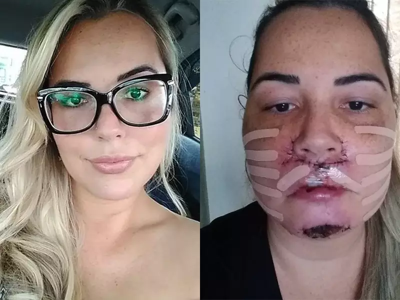 Fala Matao - Influenciadora luta para reconstruir rosto após procedimento estético malsucedido