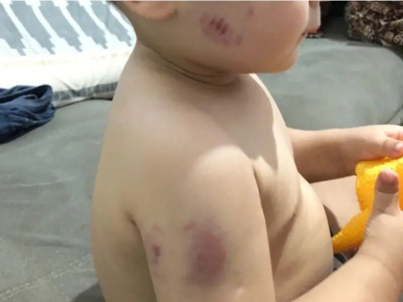 Fala Matao - Bebê de 1 Ano e 7 meses sofre 9 mordidas em creche particular de São Carlos